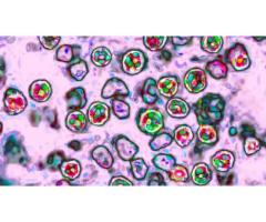 В округе Orange у местного жителя обнаружили корь